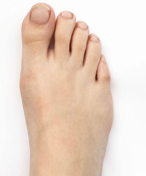 I cured my thumb valgus with the Hondro Sol Valgus spray