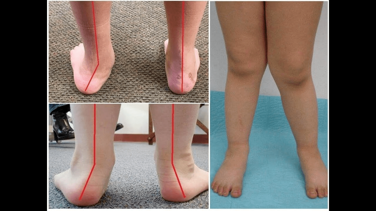 Types of deformations