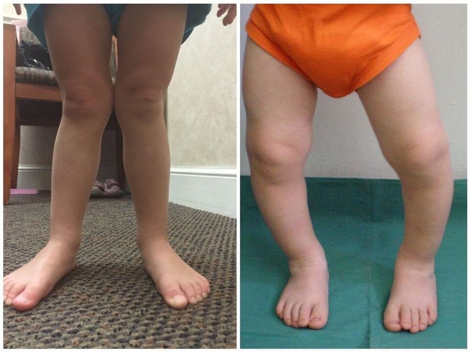 Valgus deformation in children causes