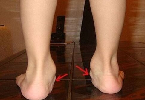 Deformation valgus of the feet in children