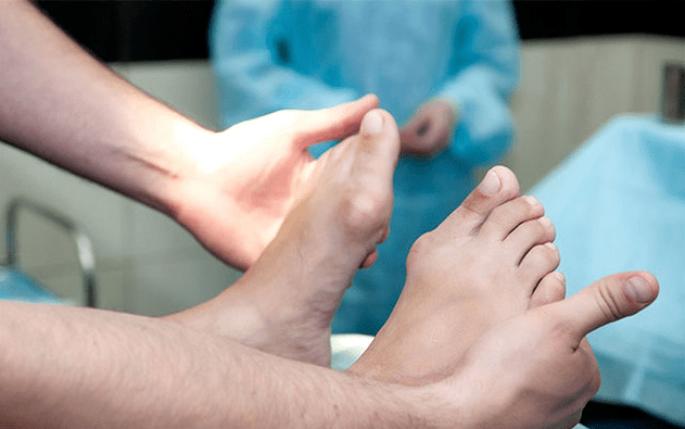 Foot valgus deformation