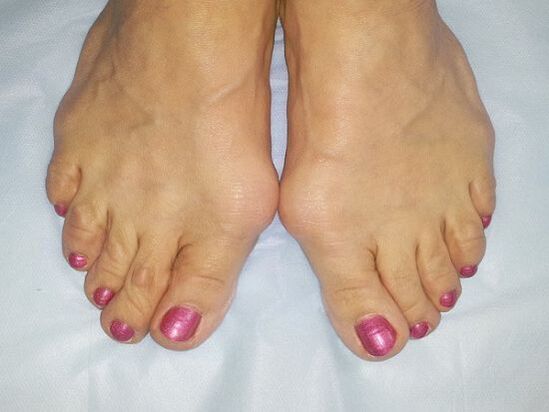 Hallux valgus of the feet
