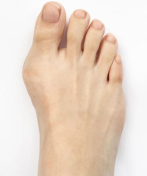 hallux valgus before using Hondro Sol Valgus spray